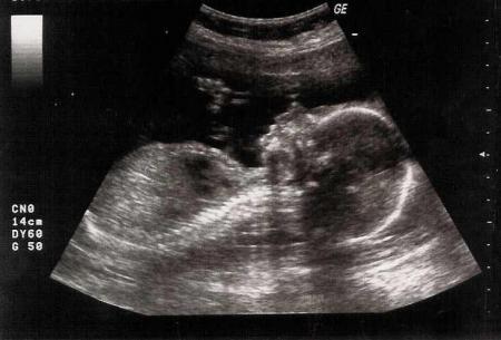 THONY echo 5�me mois